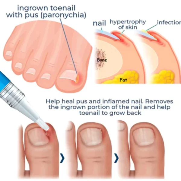 Oveallgo™ Removal Paronychia Gel