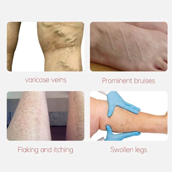 Oveallgo™ Varicose Veins Relief Cream