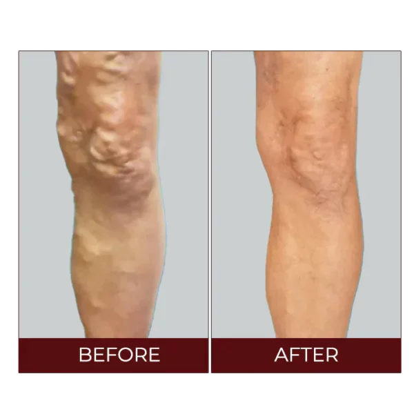 Oveallgo™ Varicose Veins Relief Cream