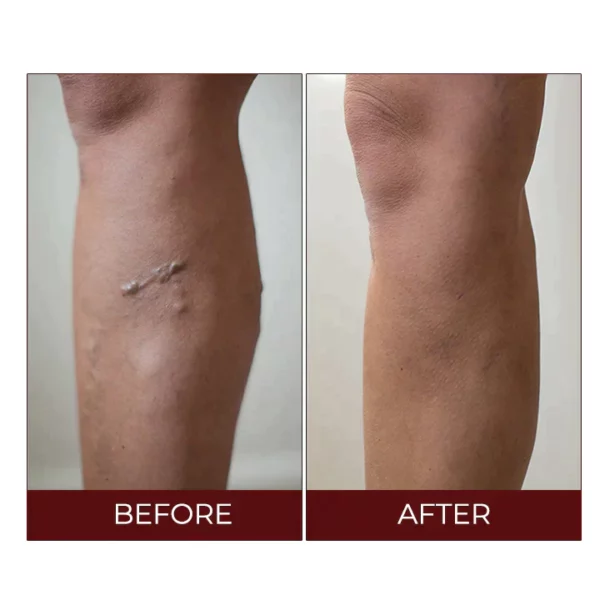 Oveallgo™ Varicose Veins Relief Cream