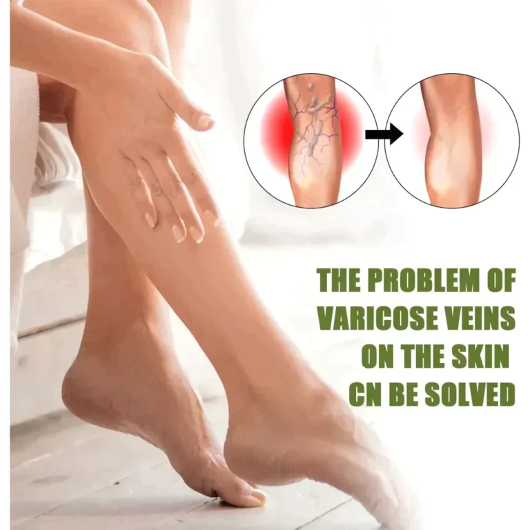 Oveallgo™ VeinEaze Varicose Veins Spray - Image 5