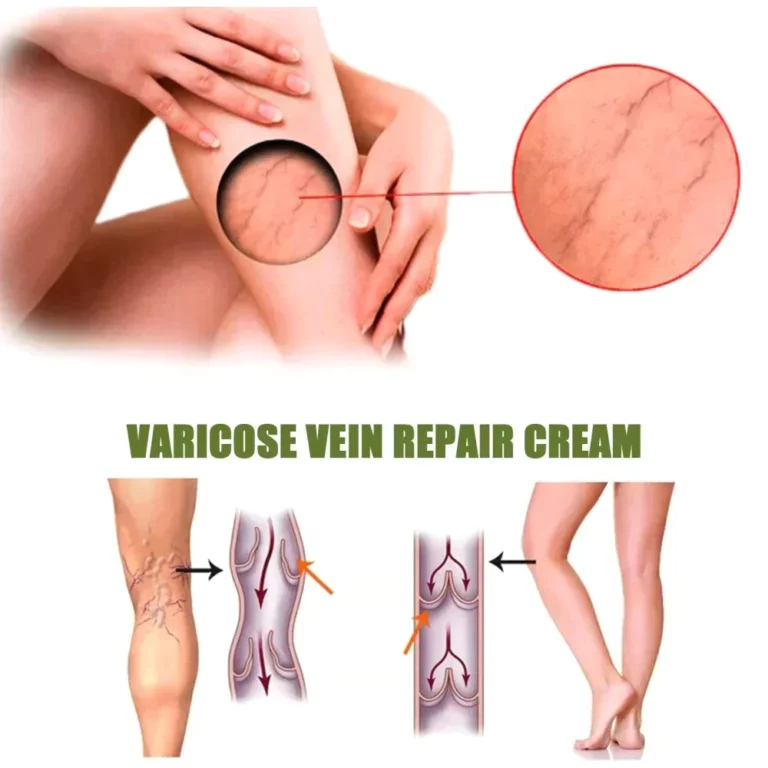 Oveallgo™ VeinEaze Varicose Veins Spray - Image 6