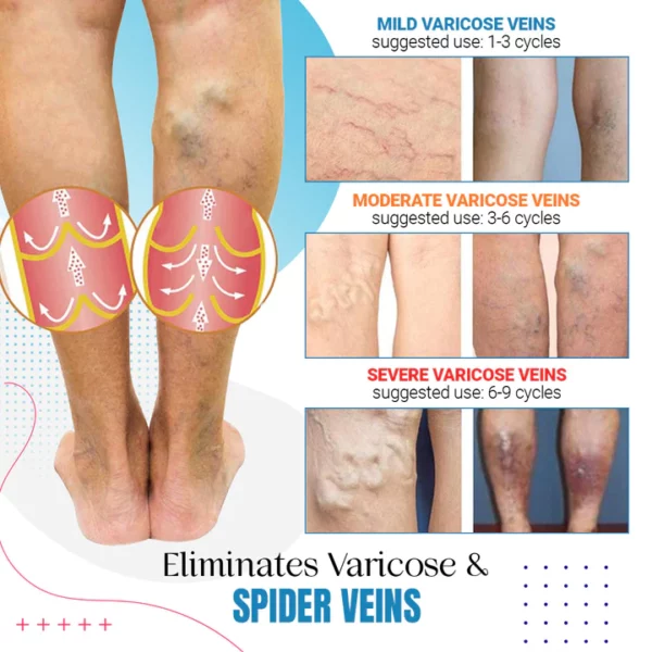 Raura™ Varicose Veins Treatment Spary