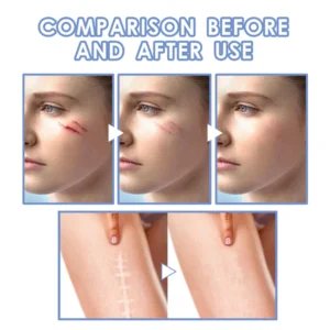 SkinRenew™ Ampoule Scar Removal Serum