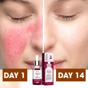 SkinRevive™ Rosacea Cure Serum