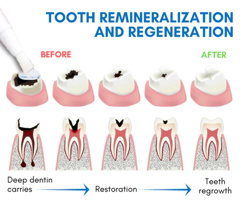 AEXZR™ Shark Cartilage Protein Dental Regrowth Gel