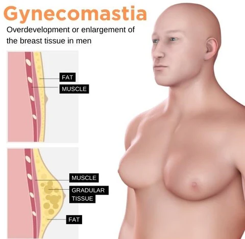 AQA™Gynecomastia Cream