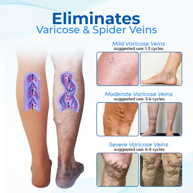 Biancat™ Legenda Varicose Vein Treatment Spray