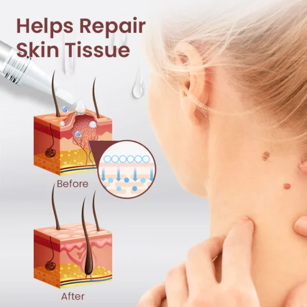 Ceoerty™ ClearSkin Mole & Tag Remover - Image 5