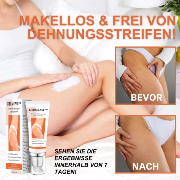 DERMEASE™ Creme zur Entfernung von Dehnungsstreifen - Image 5