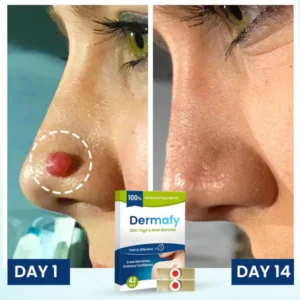 Dermafy™ Skin Tags & Mole Remover