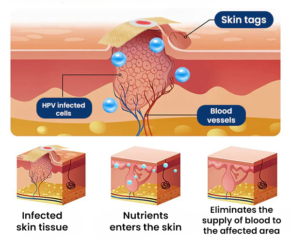 Dermafy™ Skin Tags & Mole Remover