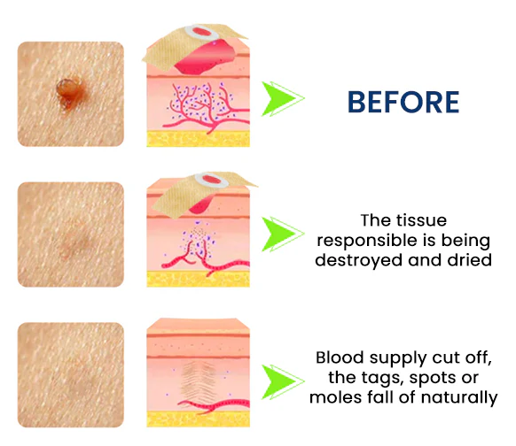 Dermafy™ Skin Tags & Mole Remover