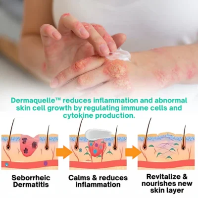 Dermaquelle™ Seborrheic Dermatitis Care Cream