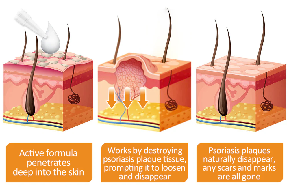 Dobshow™ Bee Venom Psoriasis Relief Cream