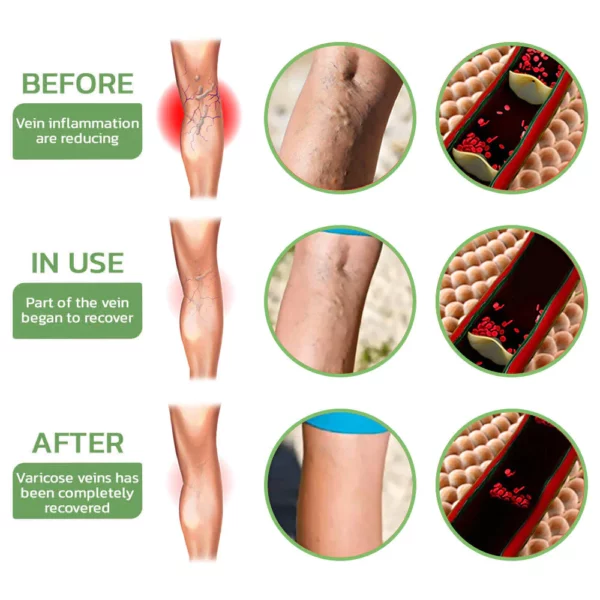 Fivfivgo™ Fat Burning Shaping & Varicose Veins Immediate Relief Burst Beads Patch - Image 4