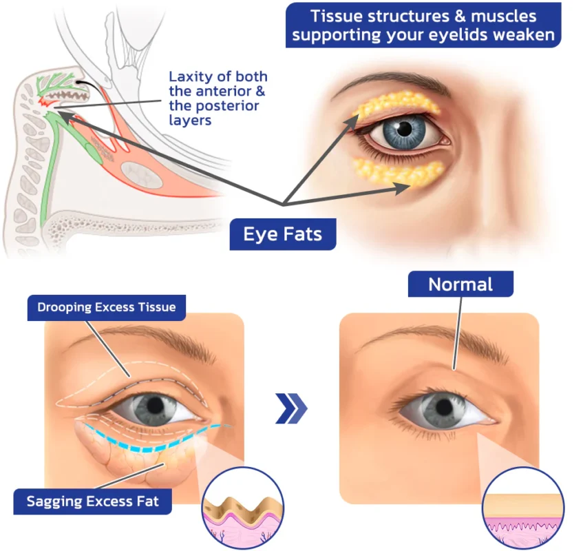 Flysmus™ OpenVision Bee Venom Lifting Eye Gel