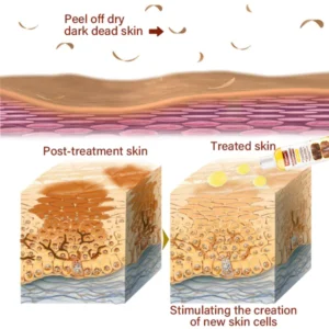 FurzeroTM Acanthosis Nigricans Peeling Oil