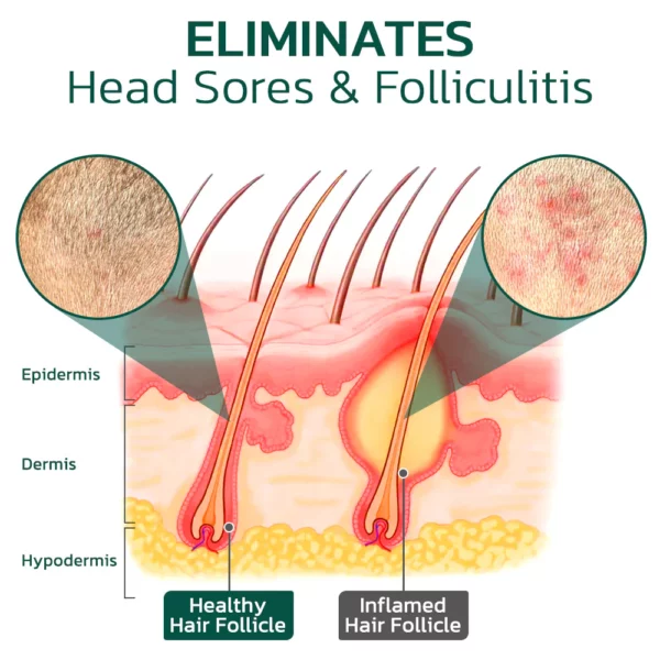 GFOUKTM Scalp Folliculitis Therapy Oil - Image 4