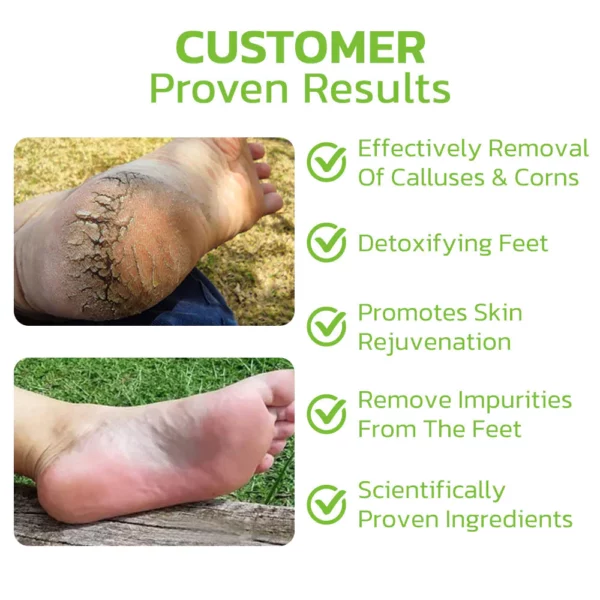 GFOUK™ IHerbal Foot Callus And Corns Removal Soak - Image 3