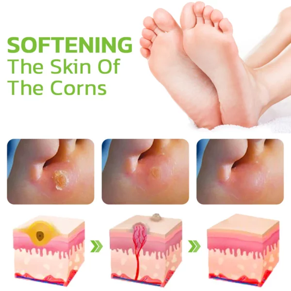 GFOUK™ IHerbal Foot Callus And Corns Removal Soak - Image 5