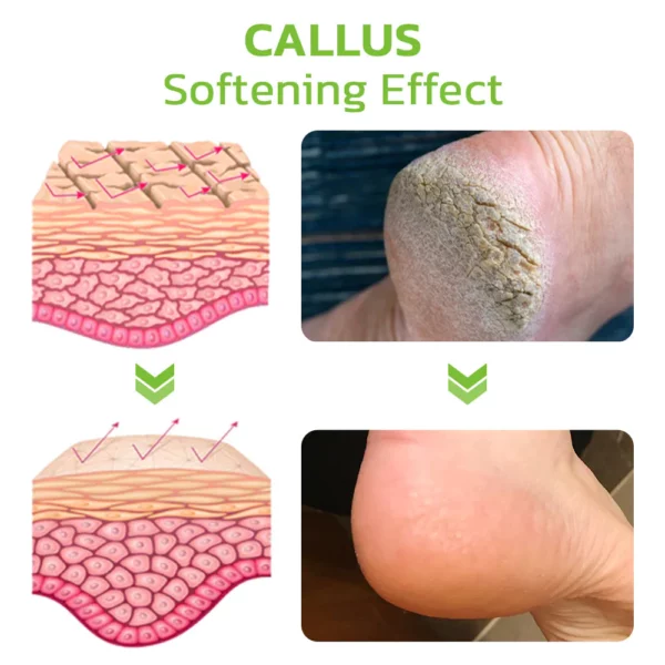 GFOUK™ IHerbal Foot Callus And Corns Removal Soak - Image 6