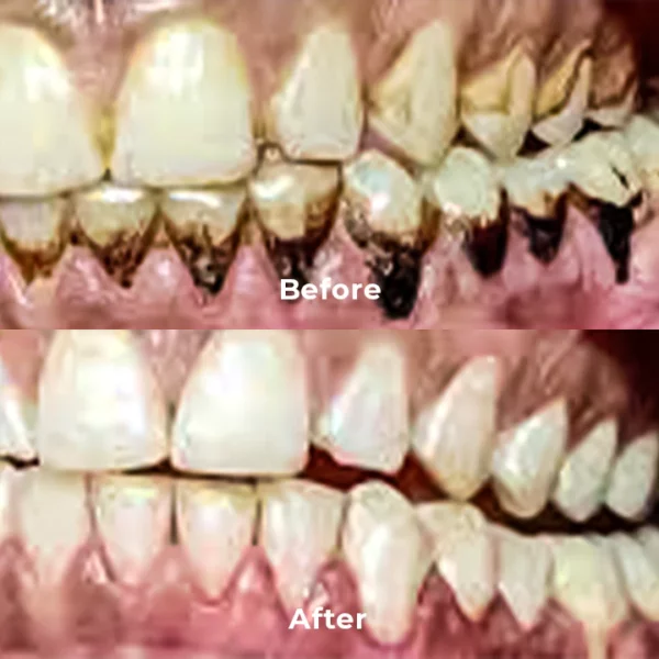 LISHUANG™ Stain Removal Toothpaste - Image 6