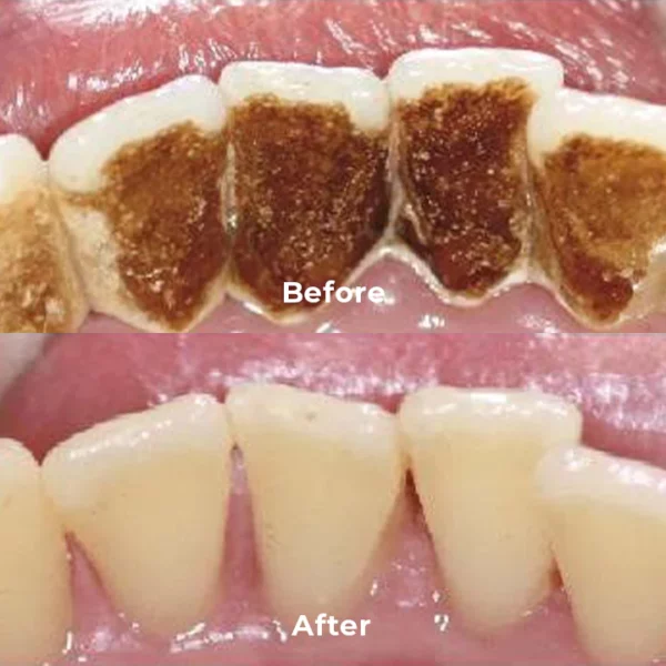 LISHUANG™ Stain Removal Toothpaste - Image 7