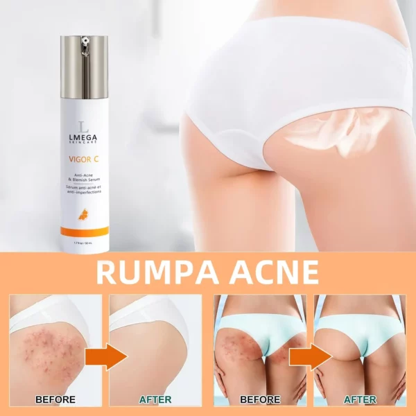 LMEGA™ VIGOR C Buttocks Acne Erasing Serum - Image 2