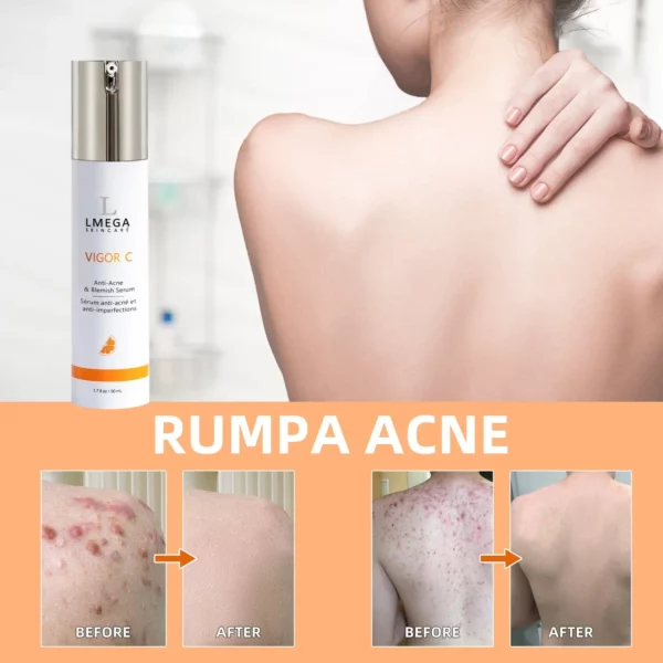 LMEGA™ VIGOR C Buttocks Acne Erasing Serum - Image 3