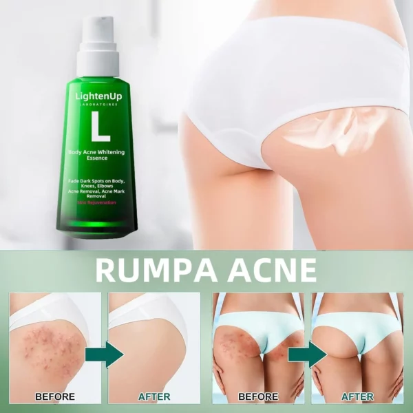 LightenUp™ Buttocks Acne Erasing Serum - Image 2