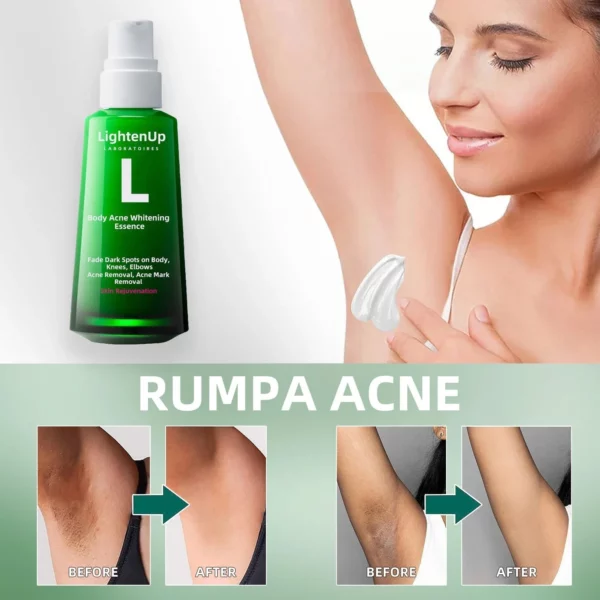 LightenUp™ Buttocks Acne Erasing Serum - Image 4