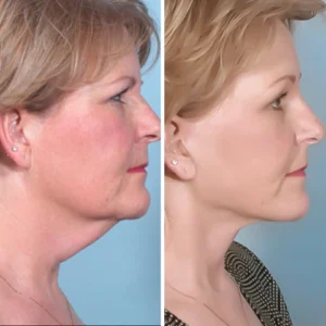 LunaLoom™ UltraRenew Ultrasonic Facelift Device