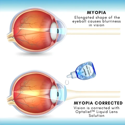 Optalief™ Liquid Lens Solution