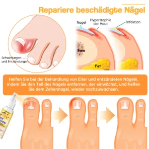 Ourlyard™ Bienengift Nagelpilz Behandlungsspray