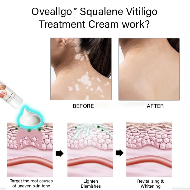 Oveallgo™ Squalene Vitiligo Treatment Cream