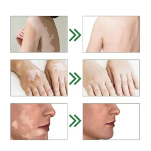 Oveallgo™ Squalene Vitiligo Treatment Cream