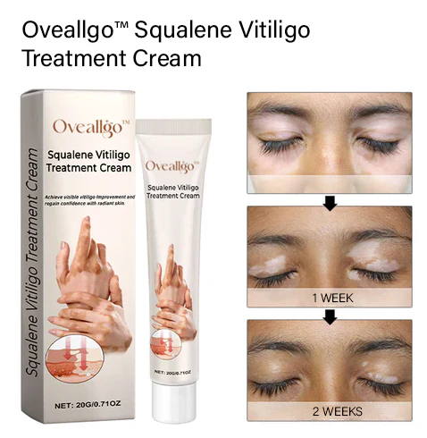 Oveallgo™ Squalene Vitiligo Treatment Cream