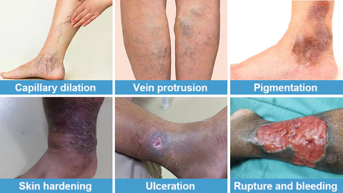 Oveallgo™ Varicose Veins Treatment Cream