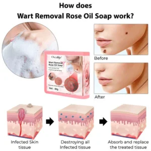 Oveallgo™ Wart NanoPURI Removal Rose Oil Soap