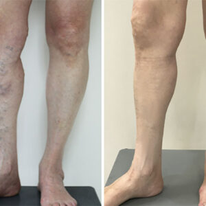 PosrystTM Blue Light Therapy Set for Varicose Veins