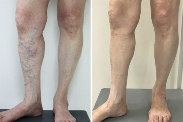 PosrystTM Blue Light Therapy Set for Varicose Veins