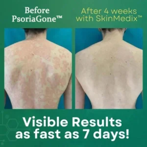 PsoriaGone™ Natural Herbaceous Plants Psoriasis Cream