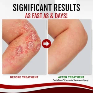 PsoriaGone™ Psoriasis Treatment Spray