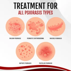 PsoriaGone™ Psoriasis Treatment Spray