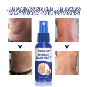 PsoriaGone™ Psoriasis relief spray