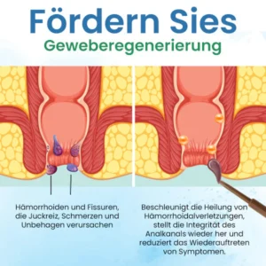 Quezy™ Hämorrhoiden Behandlung Gel