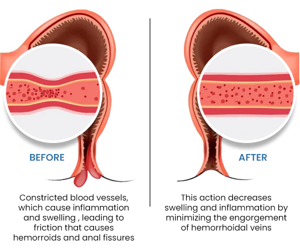 Quezy™ Hemorrhoids Treatment Gel