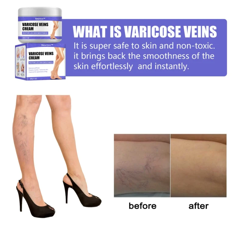 Seurico™ Varicose Veins Cream