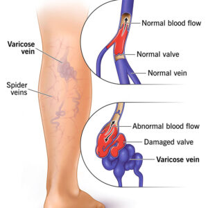 Seurico™ Varicose Veins Cream